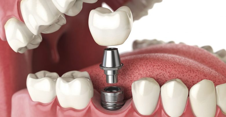 dental implant bukit timah